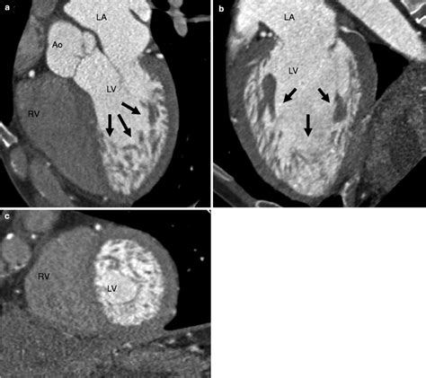 left ventricular noncompaction radiology.